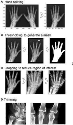 Development of a deep learning model for automated detection of calcium pyrophosphate deposition in hand radiographs